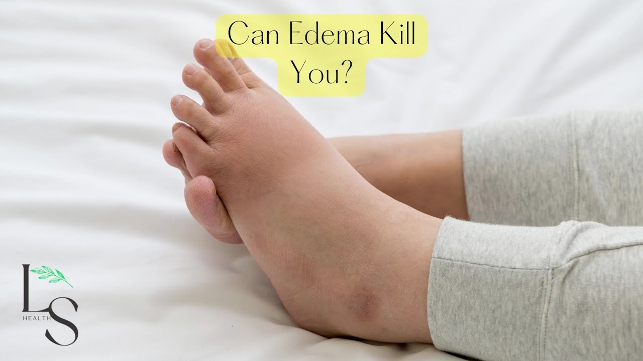 Can Edema Kill You YouTube