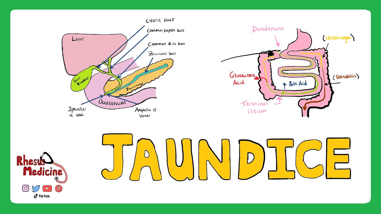 prehepatic jaundice case study