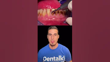 ¿Merece la pena el raspado dental?