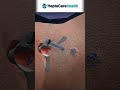 Fistula Problem? Permanent Laser Treatment Explained 🔥