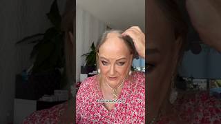 Alopecia Patches Here and Here? Watch How Hair Toppers Cover Everything Perfectly! | UniWigs Amber