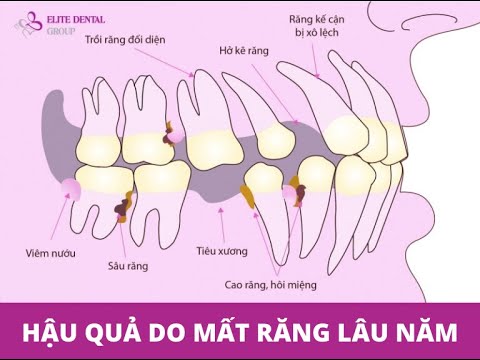 Video: 3 cách để xử lý tình trạng mất răng