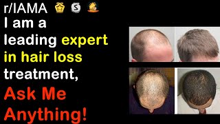 How does the future of hair loss treatment look | r/IAMA | Reddit
