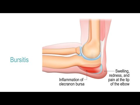 Video: Bursitis behandelen (met afbeeldingen)