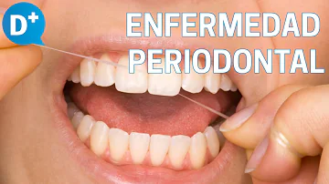 ¿Cómo se cura la enfermedad periodontal sin un dentista?