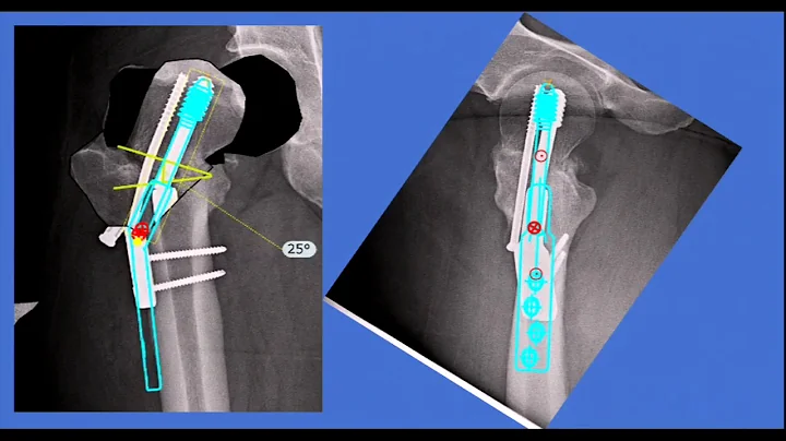 Hip fractures - Panel discussion