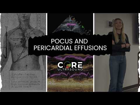 Ultrasound Diagnosis of Pericardial Effusion and Tamponade in the ED