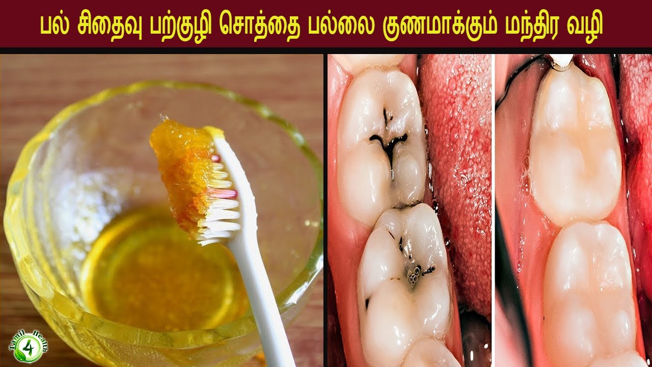 பற்குழி பல் சொத்தையை குணமாக்க மந்திர வழி | Magic Way to REVERSE CAVITIES