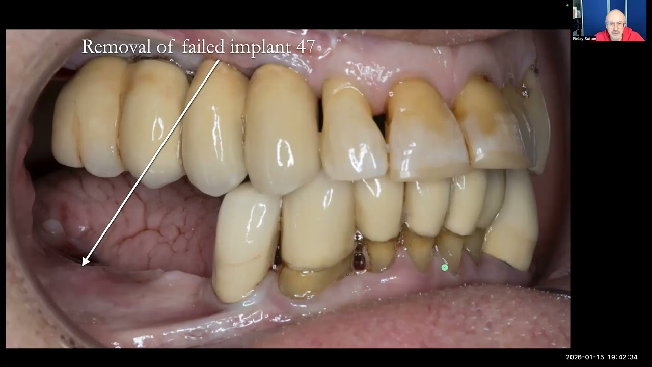 Managing missing teeth and failing dentitions | Ken – Study Club Live Finlay Sutton