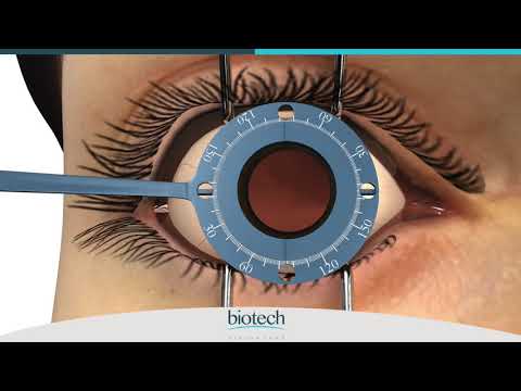Eyecryl TORIC Range Axis Marking & Implantation Guide