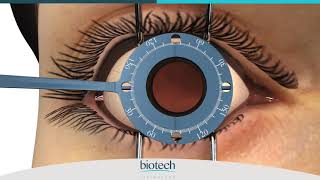 Eyecryl TORIC Range Axis Marking & Implantation Guide