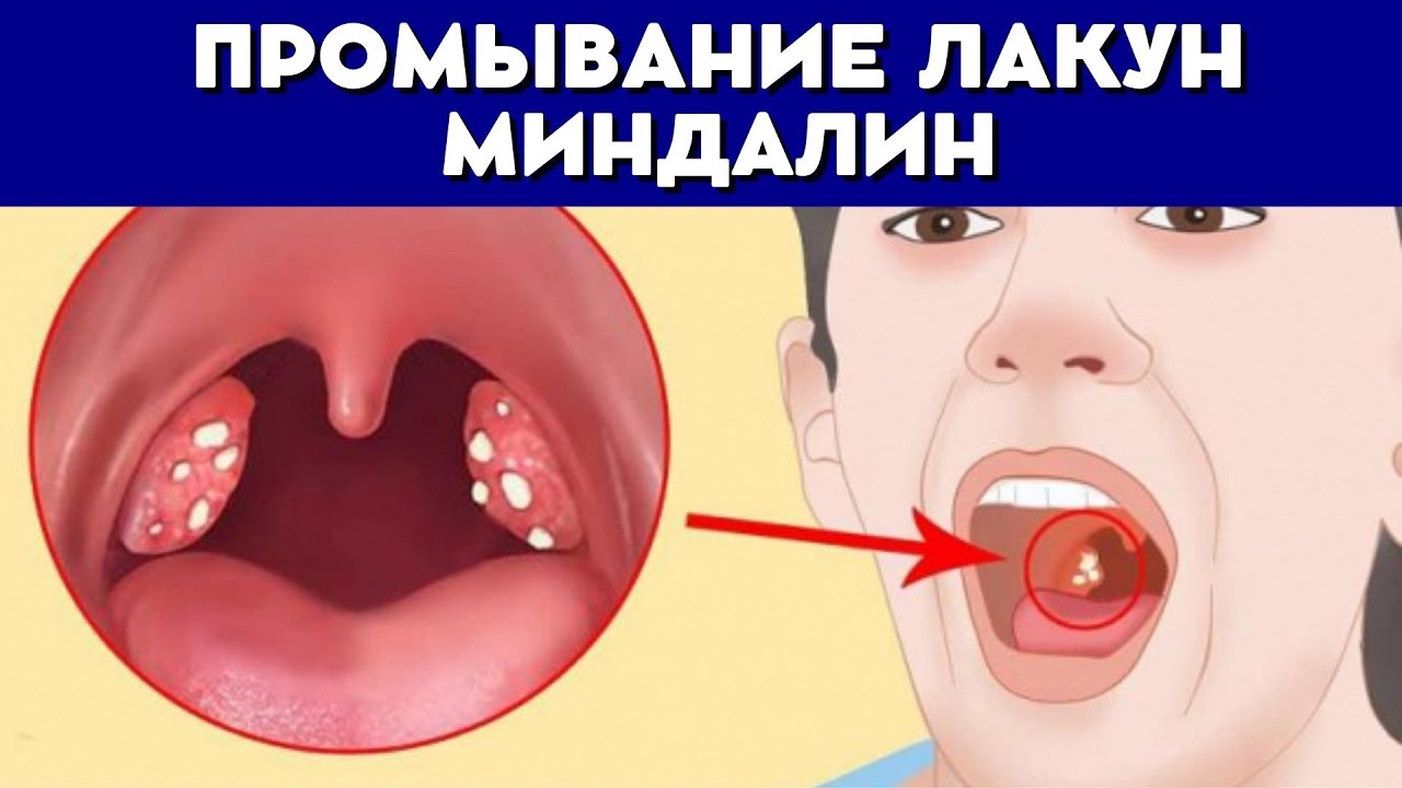 Промывание ЛАКУН миндалин - YouTube