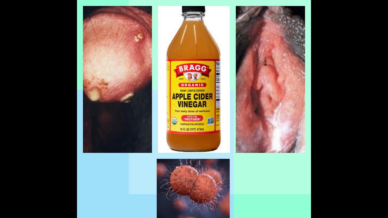 How To Cure STD GONORRHEA At Home WATCH CAREFULLY Do s And Don how-to-cure-std-gonorrhea-at-home-watch-carefully-do-s-and-don