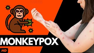 Monkeypox: Everything You Need To Know