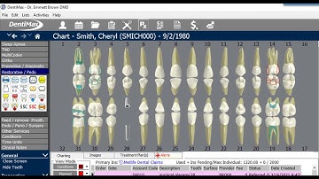 How to use the Downgrade feature in DentiMax