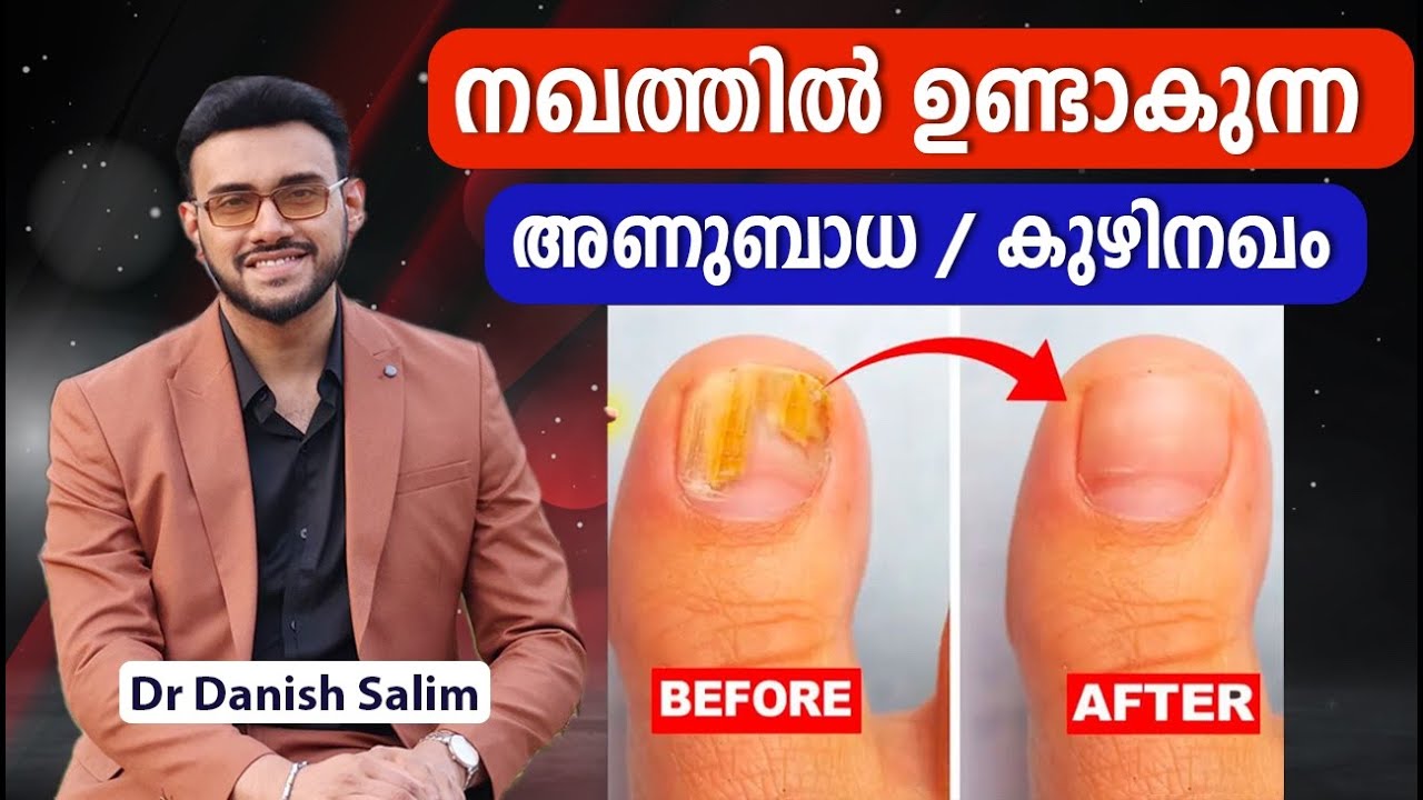 2085 : നഖങ്ങൾ നിറം മാറിയാൽ?  കുഴിനഖം /അണുബാധ എങ്ങനെ മാറ്റാം? |Colour Change & Infection in Nail