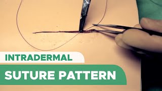 Intradermal Suture Pattern Subcuticular Suture Intracutaneous Suture