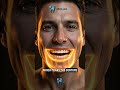 Implant supported dentures