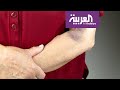 صباح العربية ما سبب ظهور البقع الزرقاء تحت الجلد