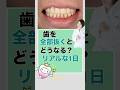 歯を全部抜くとどうなるの?リアルな1日#総入れ歯の仮歯#入れ歯 #総入れ歯 #ドイツ式入れ歯