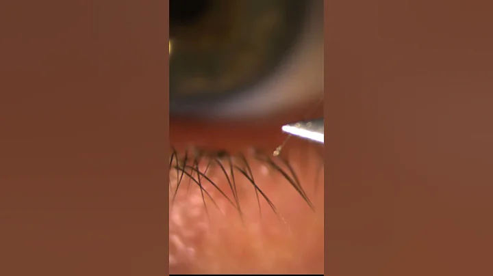 Eyelid Mite Infestation:  Demodex