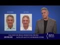 Face lift expert  azul plastic surgery sugar land houston tx