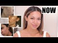 HOW I GOT RID OF ACNE + MY SKINCARE FAVORITES | Marie Jay