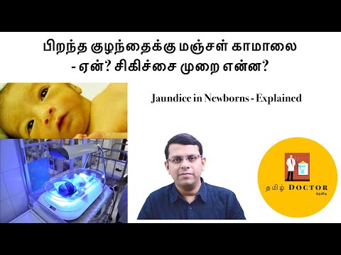 பிறந்த குழந்தைக்கு மஞ்சள் கமாலை | ஏன்? சிகிச்சை முறை என்ன?| புதிதாகப் பிறந்த குழந்தைகளில் மஞ்சள் காமாலை - விளக்கப்பட்டது| தமிழ்