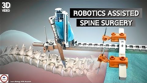 Robot-Assisted Spine Surgery Animation