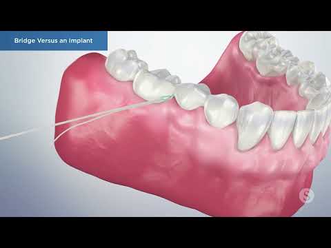 Dental Implants vs Bridges for Missing Tooth