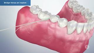 Dental Implants vs Bridges for Missing Tooth