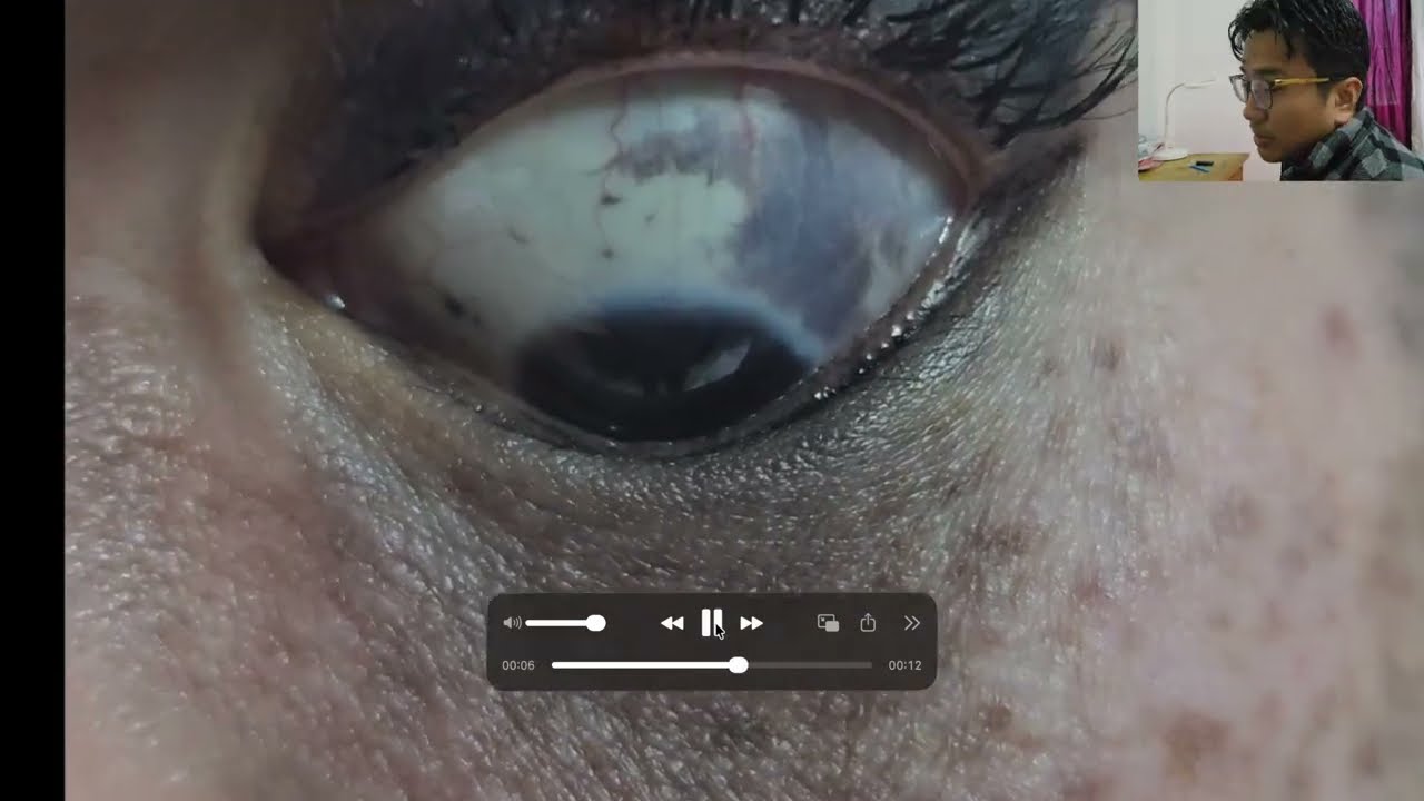 Dont Miss this Diagnosis | Naevus of Ota