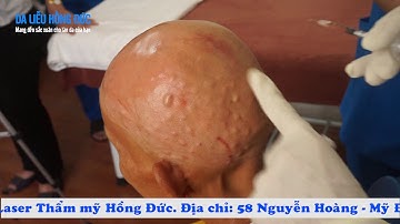 Điều trị rụng tóc bằng công nghệ PRP