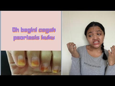 Video: Tips Membuat Suntikan Lebih Mudah Dengan Psoriatic Arthritis