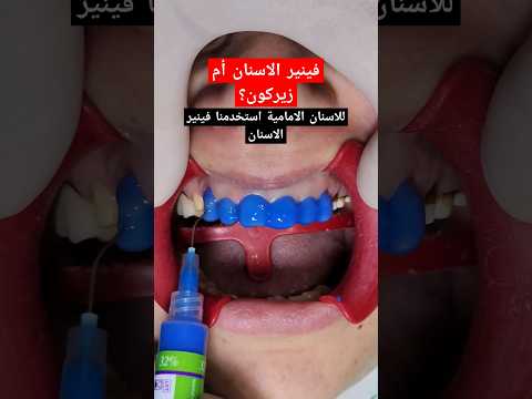 فينير الأسنان ام تلبيسات زيركون