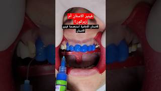 فينير الأسنان ام تلبيسات زيركون؟ | Veneers vs Zirconia