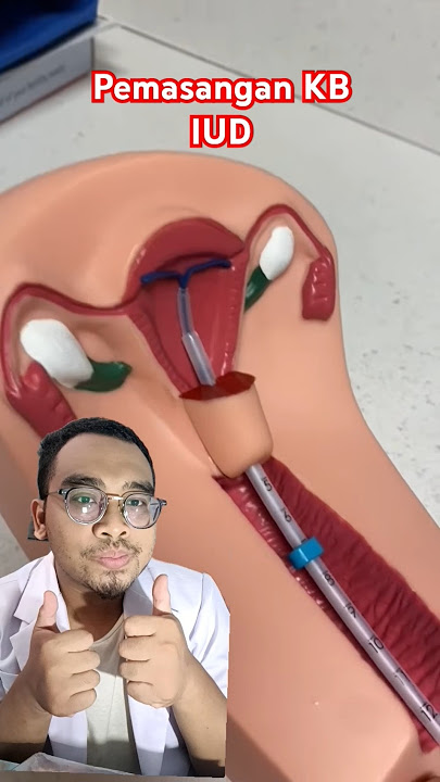 PEMASANGAN KB IUD (AKDR) #kontrasepsi #alatkontrasepsi #kb #keluargaberencana #medis #kesehatan #fyp