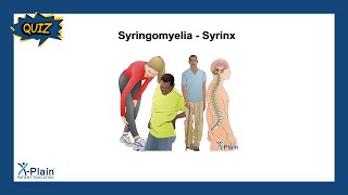 Syringomyelia - Syrinx - Quiz