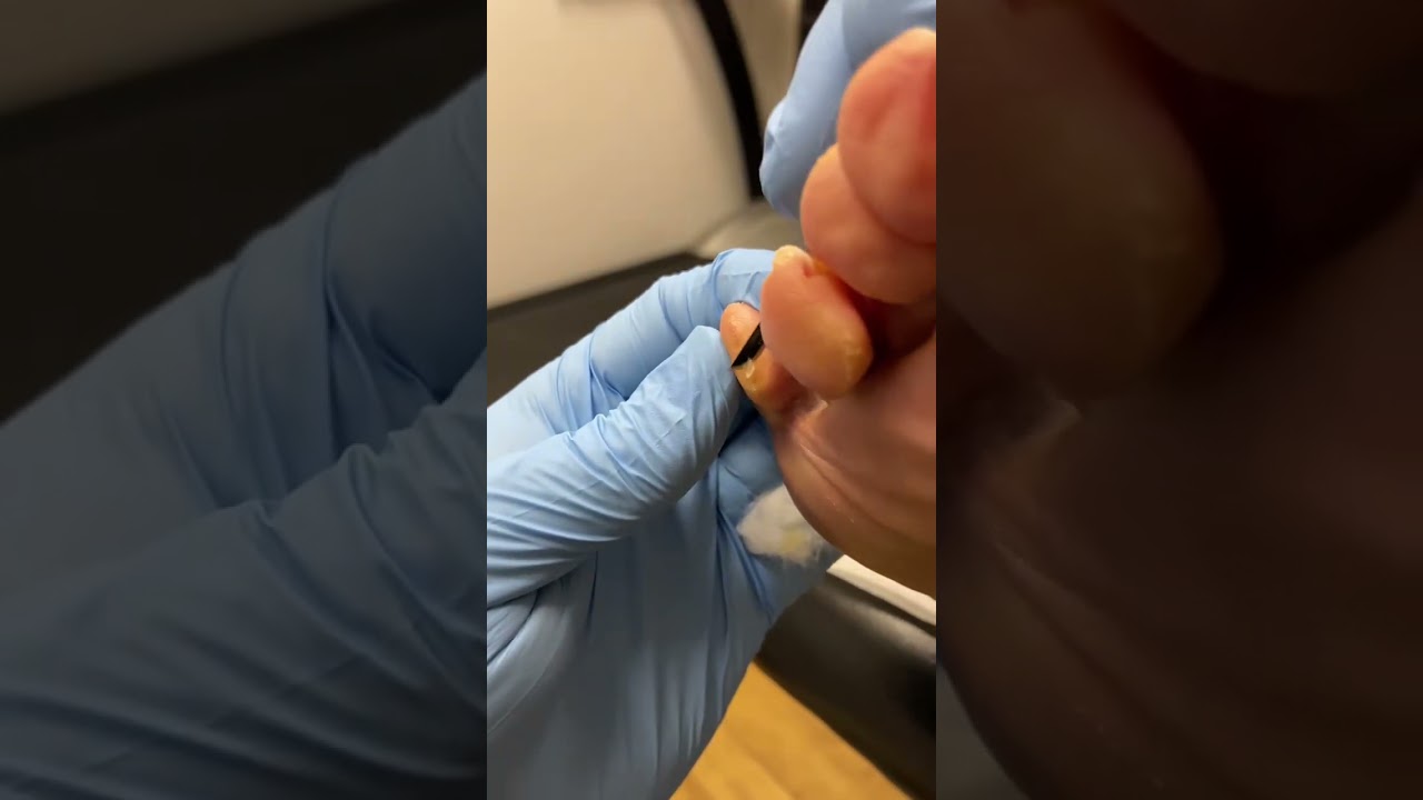 Tyloma / Pinch Calus removal by australian . Podiatrist with a scalpel