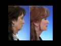 Facial Rejuvenation - Advanced Facelift Plastic Surgery Testimonial