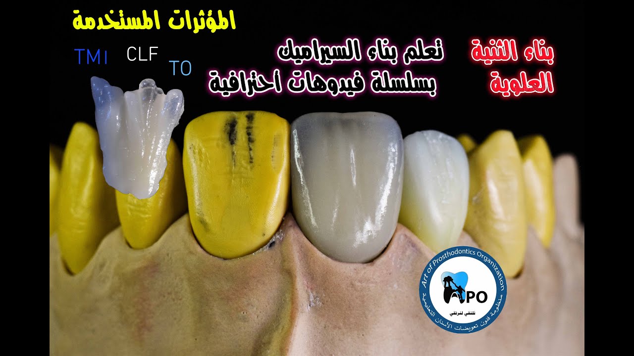 Build up ceramics بناء الثنيةالعلوية