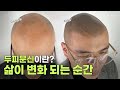 두피문신 데모모델을 하기 위해 부산에서 오게 된 리얼 후기! ㅣ두피문신 시술은 이런곳에서 받아야 합니다!