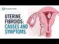 What Are Fibroids?