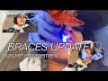 BRACES UPDATE TINY VLOG 🤓| bracket replacement + store walk thru + driving lessons | N’finidii