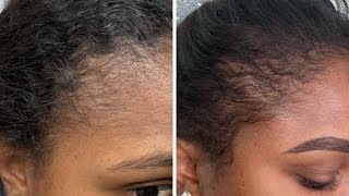 Postpartum Hair loss, what I did to grow my hair back