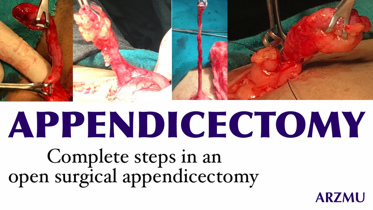 Open Appendectomy Open Appendicectomy Complete