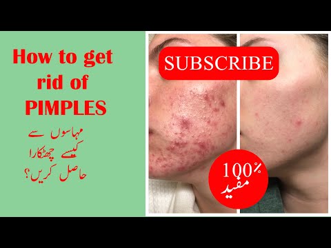How to get rid of Pimples|3 Remedies to try at home|مھاسو سے کیسے چھٹکارا حاصل کریں| URDU|HINDI