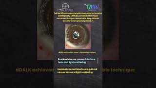 TMW#56 Residual stromal interface in pdDALK causes haze and light scattering