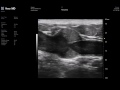 UHJ 48 MHz - Arm Vein with Valve