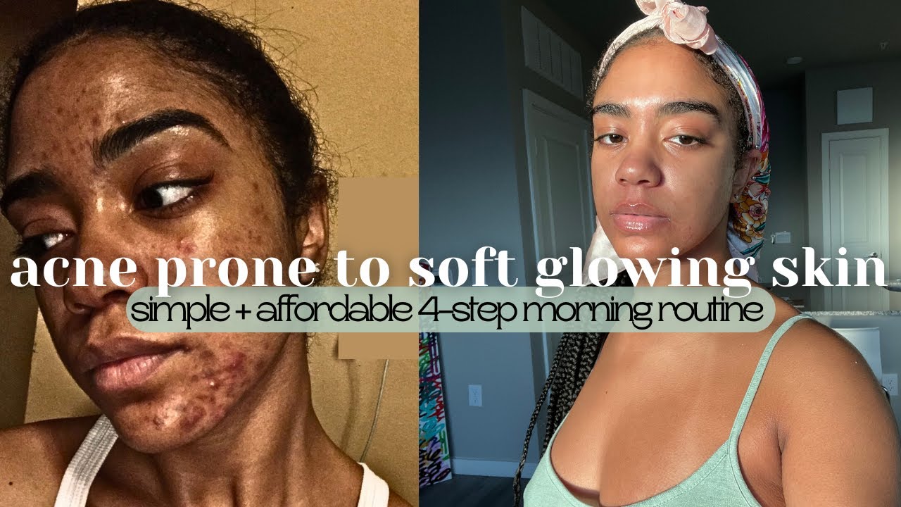 Clear Acne Prone Skin